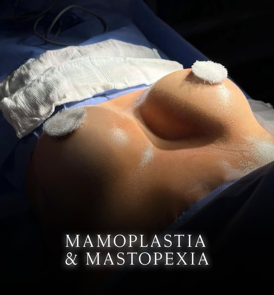 Resultado quirúrgico de mamoplastia y mastopexia — SRBC