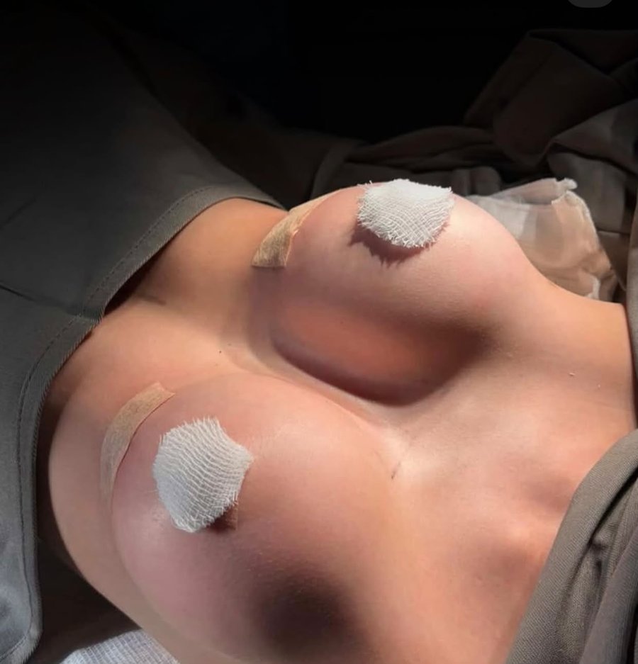 Resultado postoperatorio de mamoplastia y mastopexia — SRBC