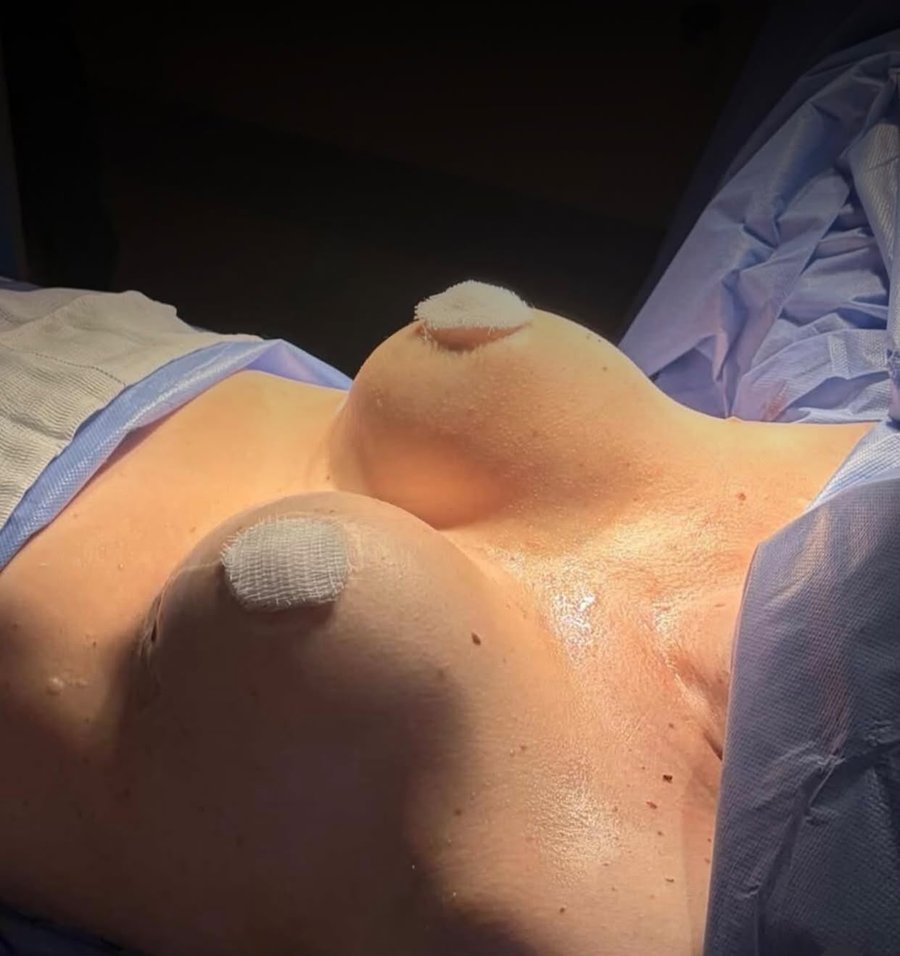 Detalle de resultado de mamoplastia y mastopexia — SRBC