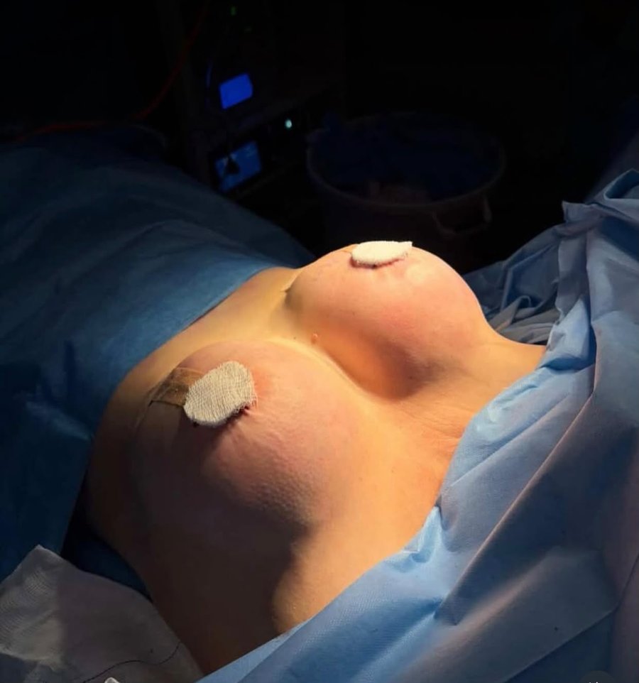 Resultado de mamoplastia y mastopexia en quirófano — SRBC